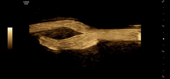 Бифуркация сонной артерии с помощью B-Flow, L2-9-D