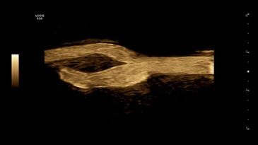 Бифуркация сонной артерии с помощью B-Flow, L2-9-D
