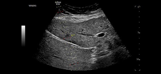 Биопсия печени с использованием насадки Verza