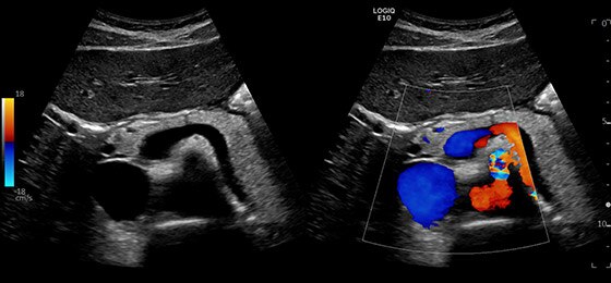 Поджелудочная железа на двойном экране с ЦДК, C1-6-D