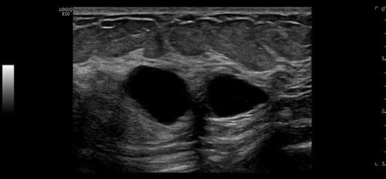 Кисты в молочной железе, ML6-15-D