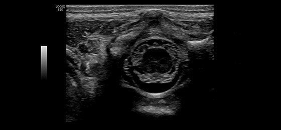 Позвоночник новорождённого, L8-18i-D