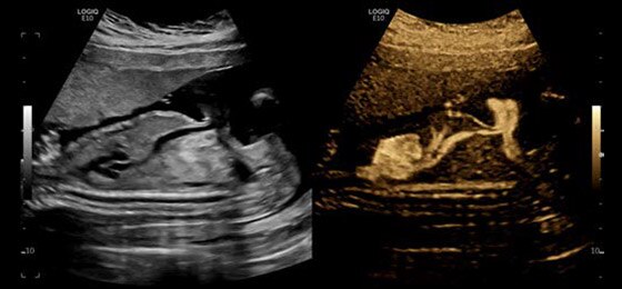 logiq-e10-ge-ultrasound_s-curve_case04_small