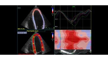 Деформация сердца, 3Sc-RS