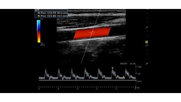 Изображения CF и PW сонных артерий, L4-12t-RS