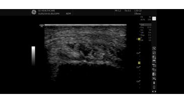 Большой палец стопы, B-Mode, L10-22-RS