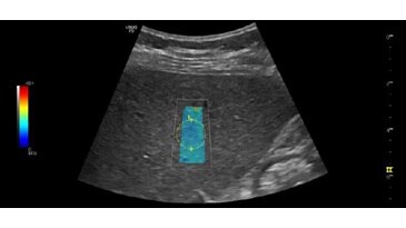 Печень, эластография сдвиговой волны, C1-5-RS
