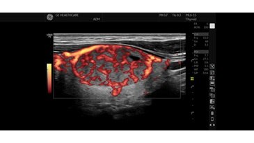 Изображение PDI щитовидной железы, ML6-15-RS