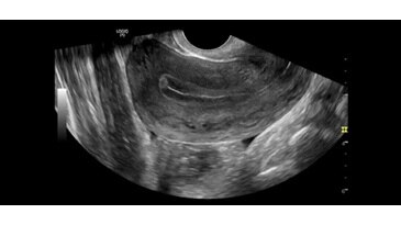Матка, B-режим, IC9-RS