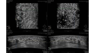 Случай 46 — 54 года, пальпируемое образование слева, инвазивная протоковая карцинома, случайно обнаруженная лобулярная карцинома справа
