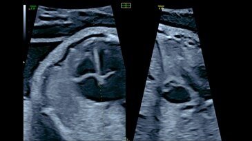 OmniView with multiple lines applied on 12-week fetus