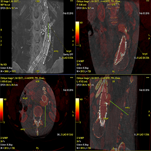 Plan-Needle-ASSIST-T2L.jpg