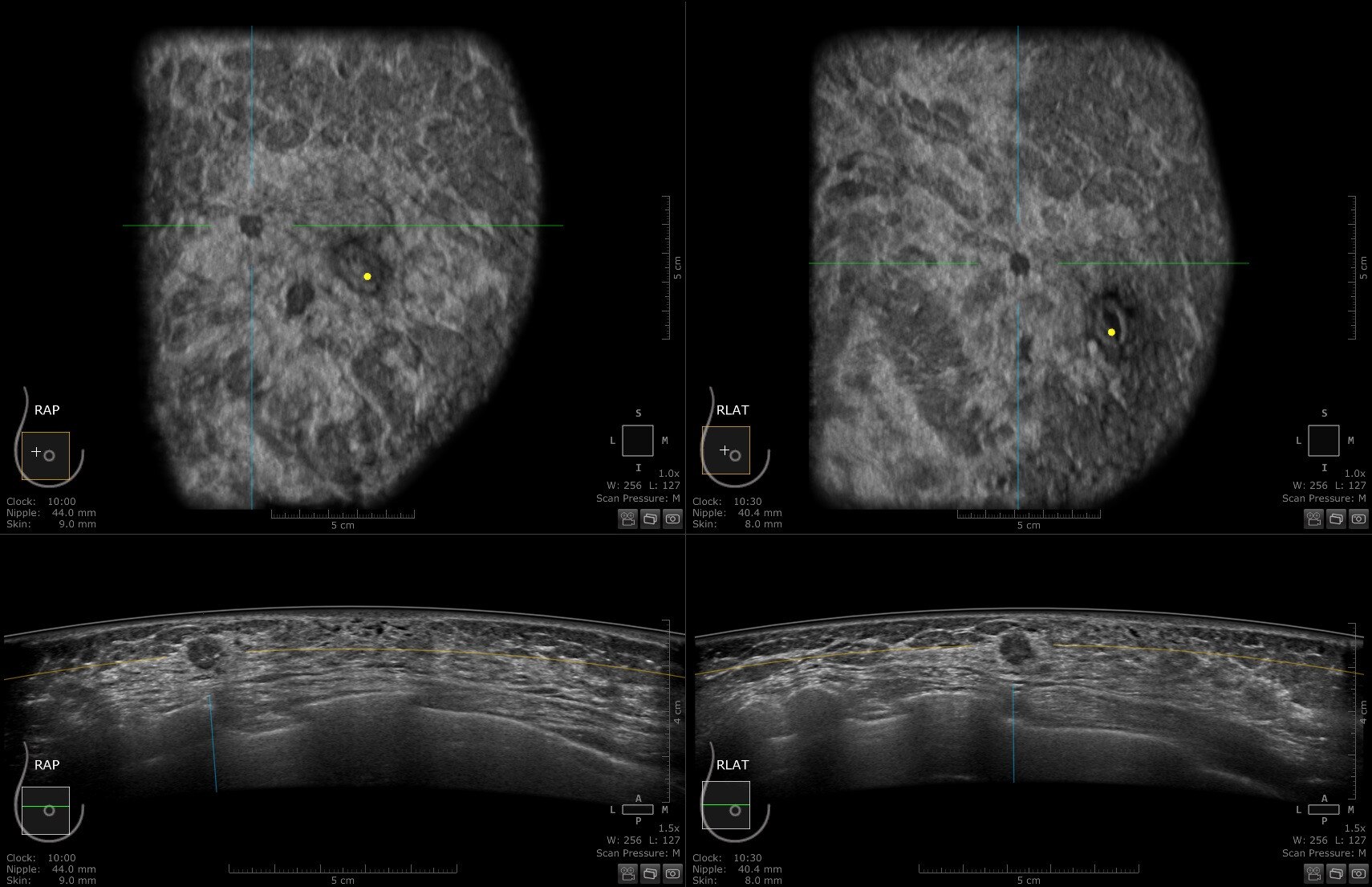 Инвазивная протоковая карцинома, подтвержденная результатами мультифокальной биопсии