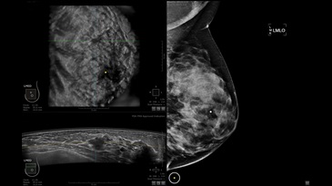 Инвазивная протоковая карцинома 2-й степени, выявленная при маммографии