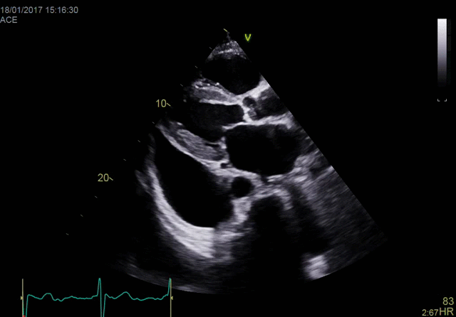 Функция True Confocal Imaging (TCI) (конфокальной визуализации)