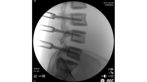 Функция Smart Metal 2