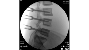 Функция Smart Metal 2