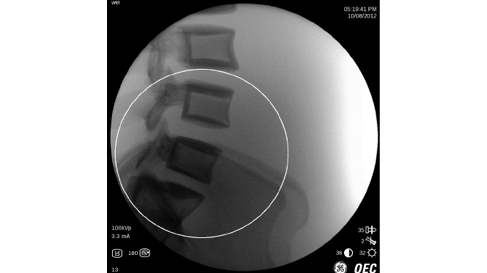 Поясничный отдел позвоночника, с функцией AutoTrak