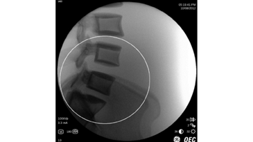 Поясничный отдел позвоночника, с функцией AutoTrak