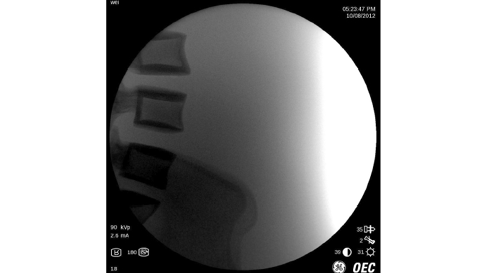 Поясничный отдел позвоночника, без функции AutoTrak