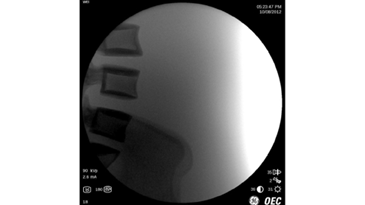 Поясничный отдел позвоночника, без функции AutoTrak