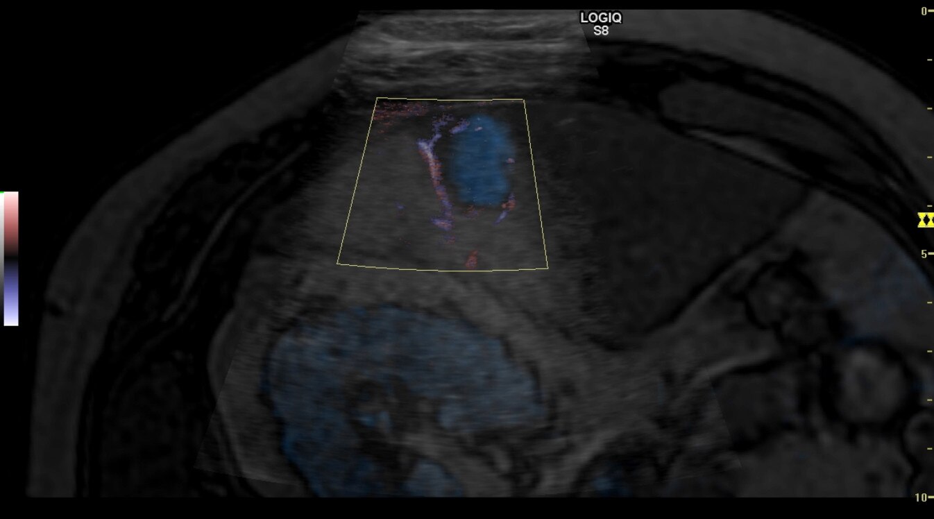 Наложение изображений при использовании объёмной навигации и цветного B-Flow