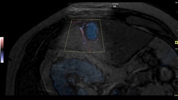 Наложение изображений при использовании объёмной навигации и цветного B-Flow