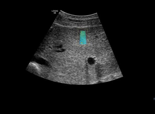 Определение степени жёсткости печени при использовании эластографии сдвиговой волны на датчике C1-6-D