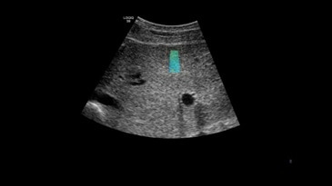 Определение степени жёсткости печени при использовании эластографии сдвиговой волны на датчике C1-6-D