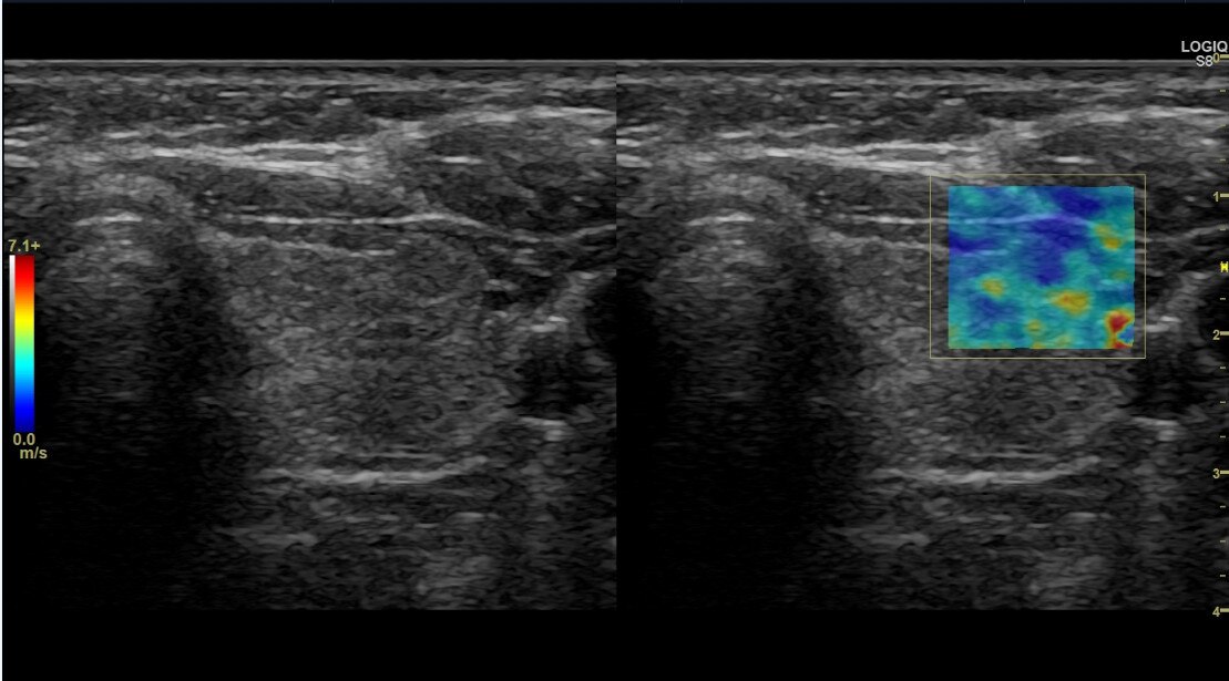 Изображение щитовидной железы при использовании эластографии сдвиговой волны на датчике С1-6-D