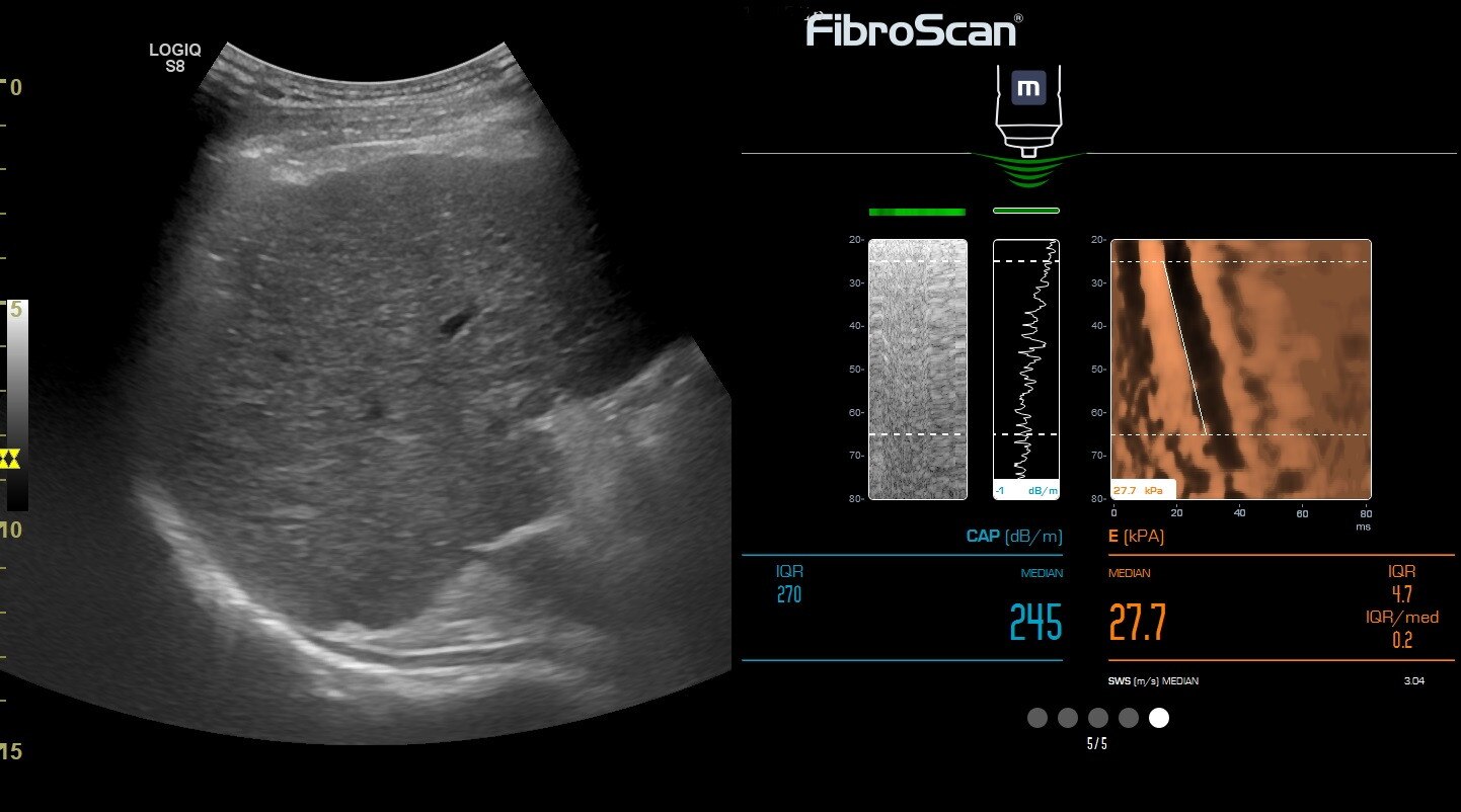 Брюшная стенка, 9L-D
