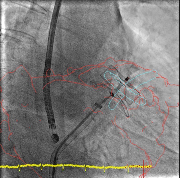product-product-categories-Intervantional - 2016-valve_22.jpg