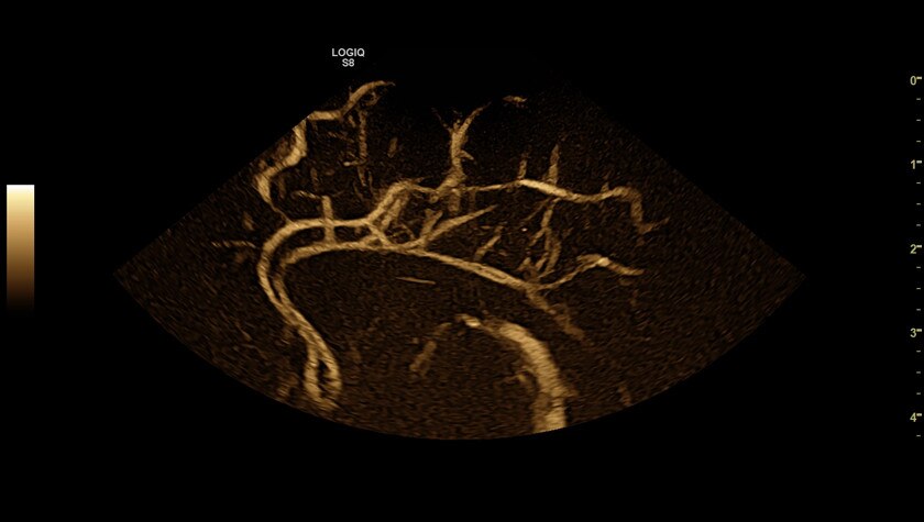 Неонатальное исследование мозга при использовании B-Flow на датчике 10C-D