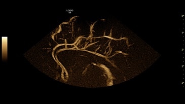Неонатальное исследование мозга при использовании B-Flow на датчике 10C-D
