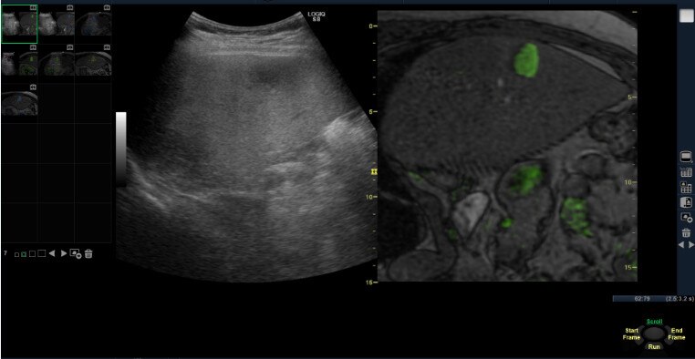 Совмещение изображений ультразвука и МРТ при использовании Объёмной Навигации 