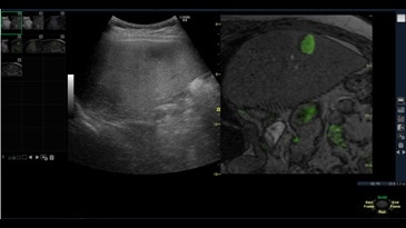 Совмещение изображений ультразвука и МРТ при использовании Объёмной Навигации