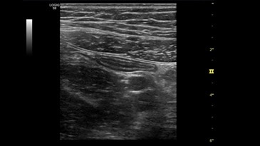Изображение аппендикса датчиком 9L-D