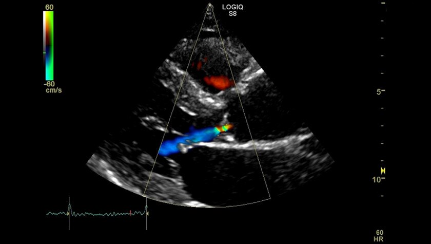 Изображение аортального клапана на датчике M5S-D