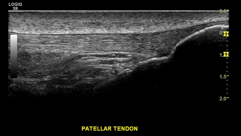 Надколенное сухожилие, ML6-15-D