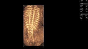 Изображение позвоночника плода на датчике RAB6-D