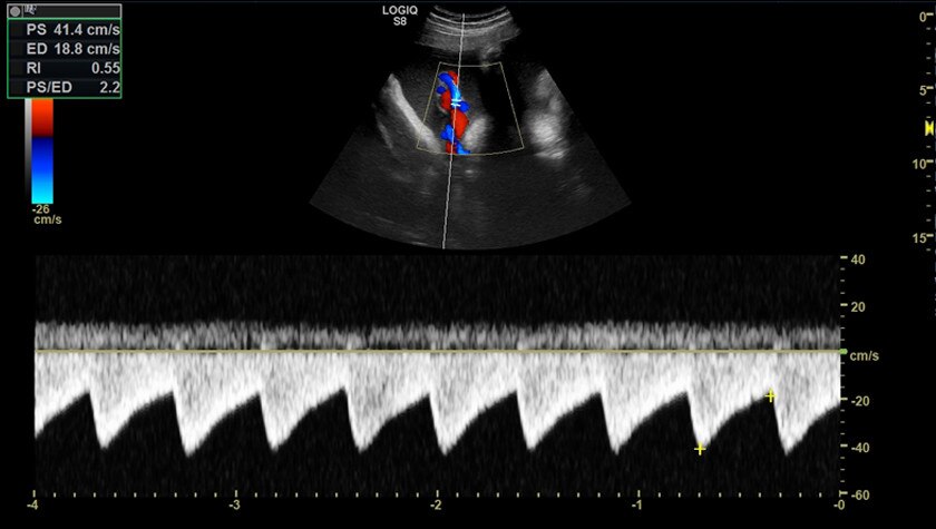 Изображение пуповины при использовании цветового допплера на датчике С2-9-D