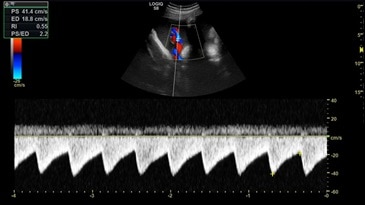 Изображение пуповины при использовании цветового допплера на датчике С2-9-D