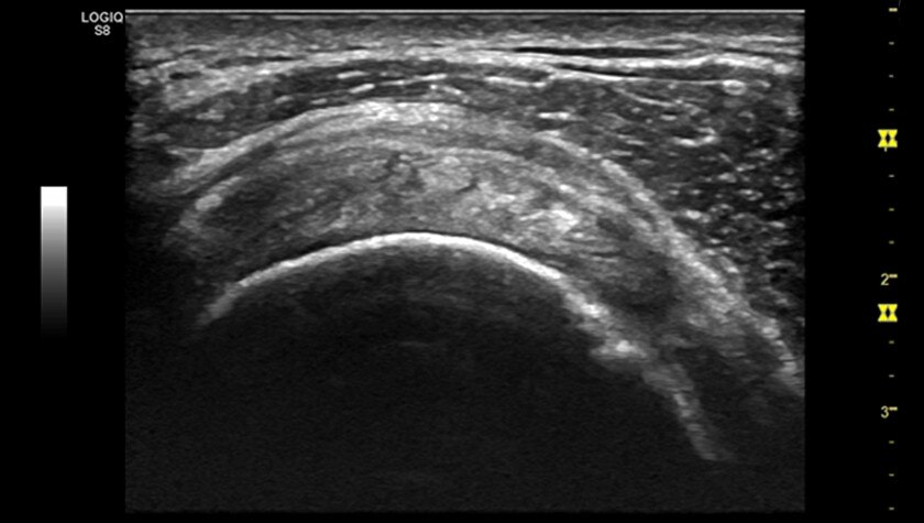 Изображение сухожилия надостной мышцы датчиком ML6-15-D