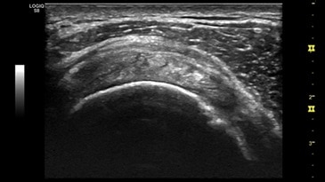 Изображение сухожилия надостной мышцы датчиком ML6-15-D