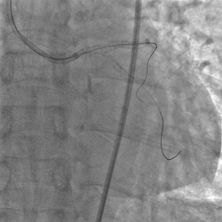 Выполнена ангиопластика по технике “kissing balloon”