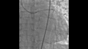 Выполнена ангиопластика по технике “kissing balloon”