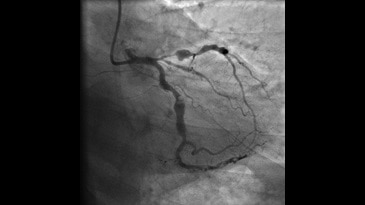 Ангиография левой коронарной артерии