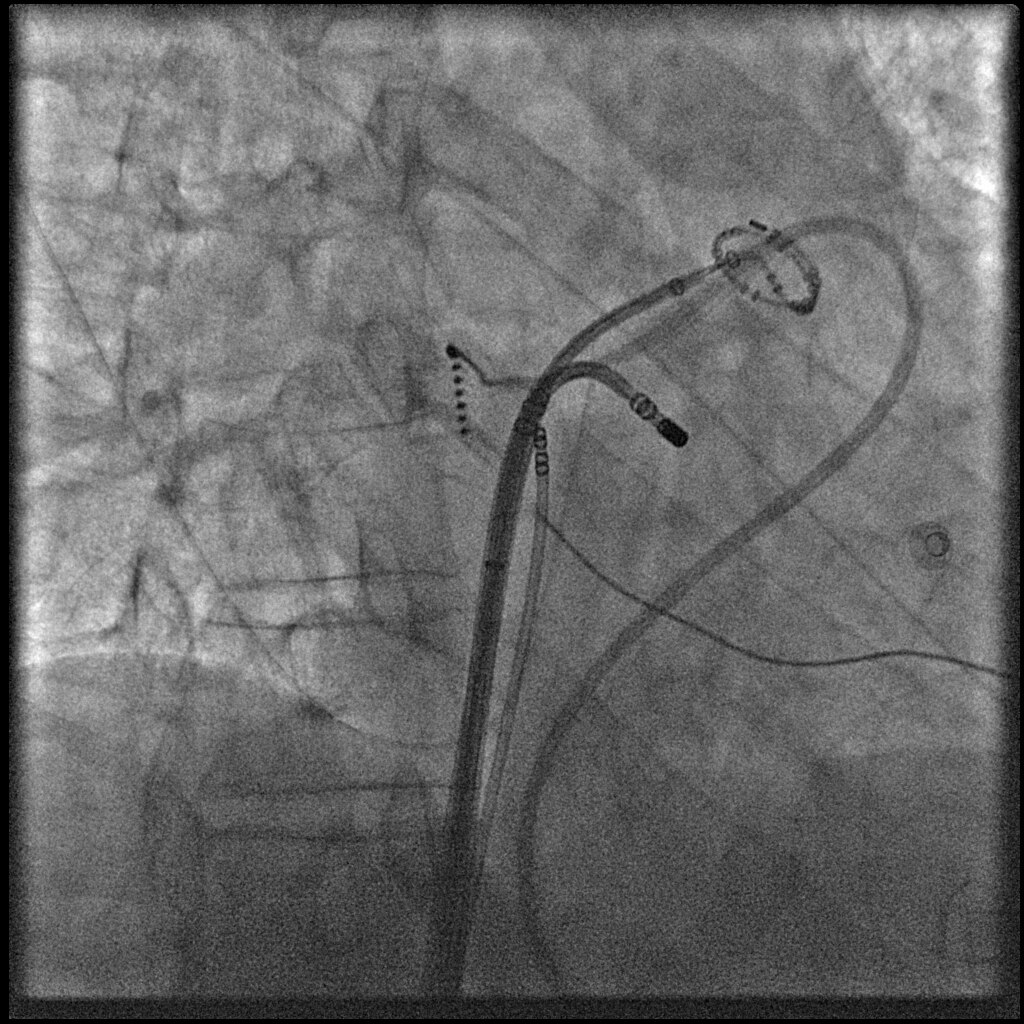 Предсердная криоабляция