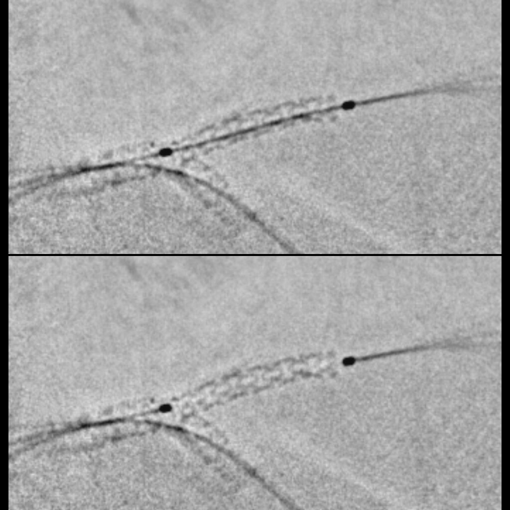 Функция StentViz обеспечивает превосходную детализацию и визуализацию границ стентов