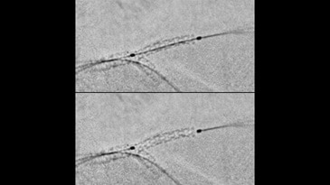 Функция StentViz обеспечивает превосходную детализацию и визуализацию границ стентов